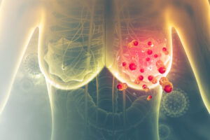 tratamiento de UNAM contra cáncer de mama