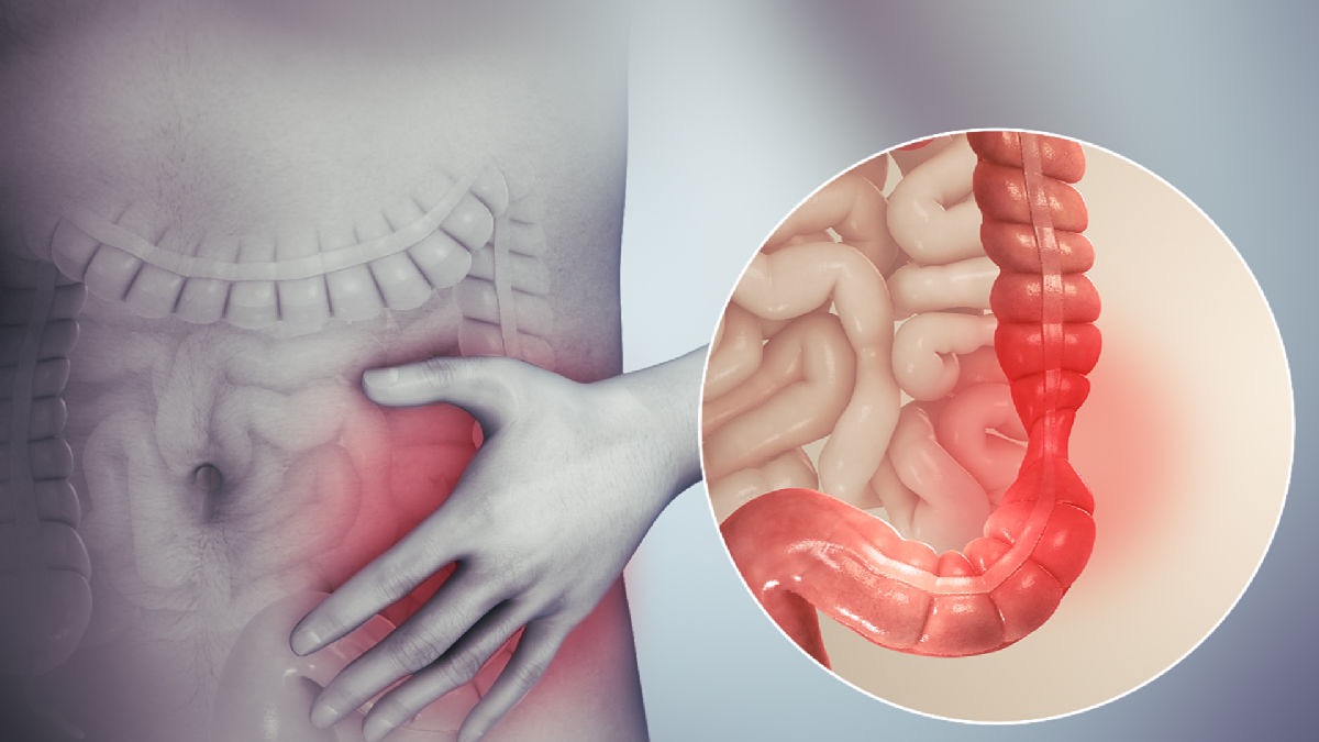 Estrés, ansiedad y depresión causan síndrome de intestino irritable