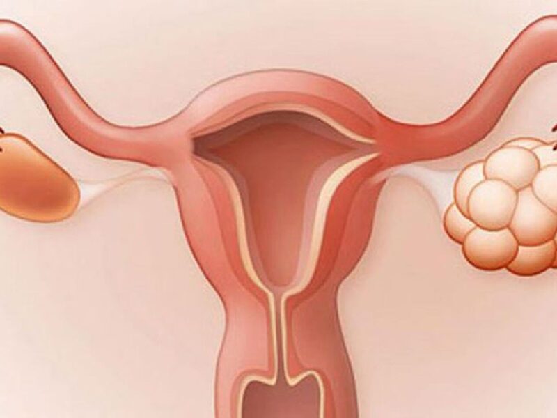 explican impacto del síndrome del ovario poliquístico