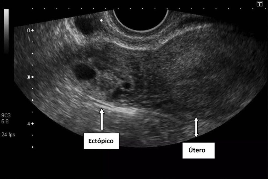 Qué es un embarazo ectópico - ultrasonido