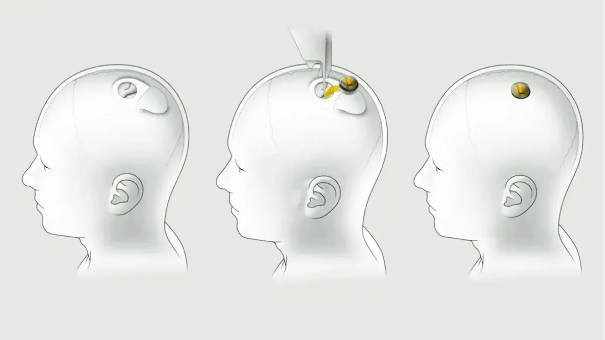 Qué tan estable y durable se mantuvo el segundo implante de Neuralink