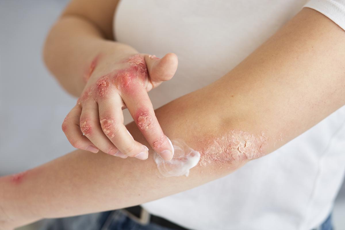 Impacto de la dermatitis atópica en niños y adultos tratamientos innovadores