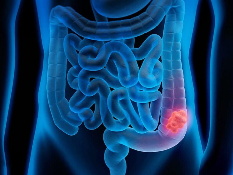 cáncer colorrectal en aumento en jóvenes de países de ingresos altos